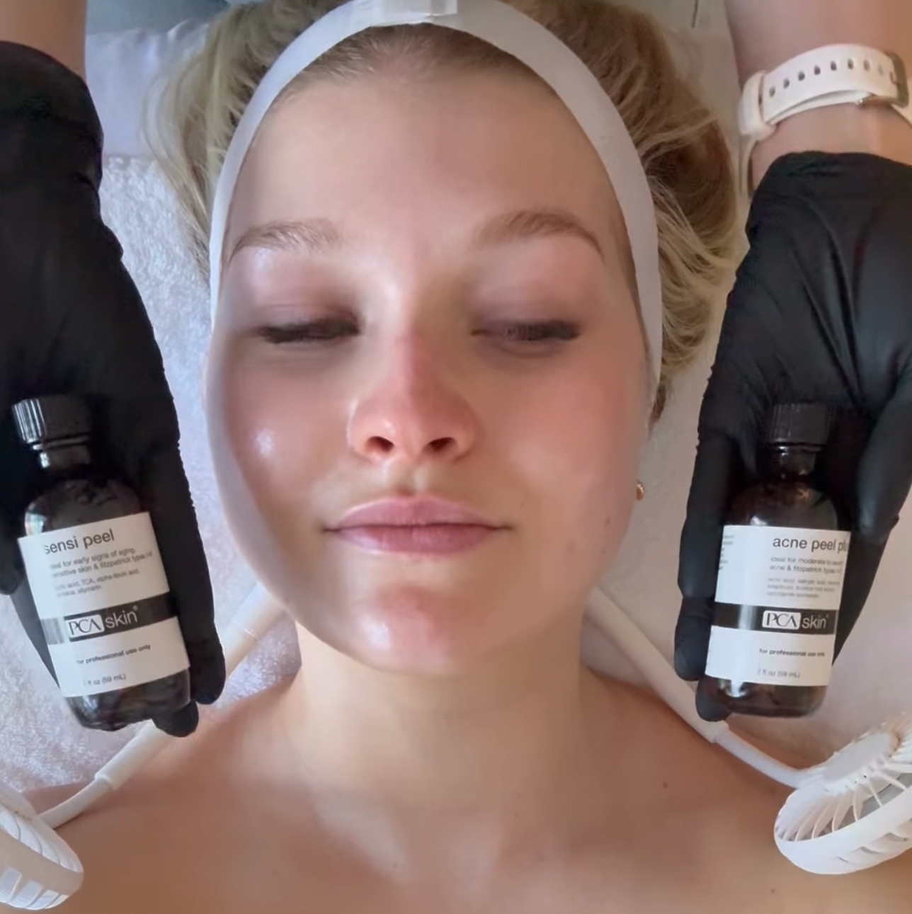 Corrective Peels: The Ultimate Reset for Your Complexion