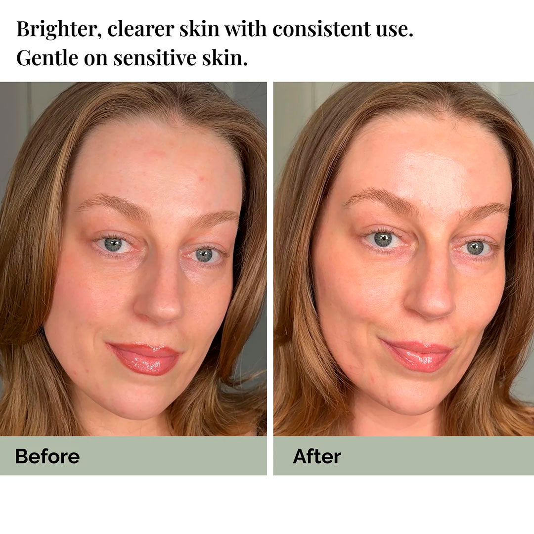 Azelaic Lotion