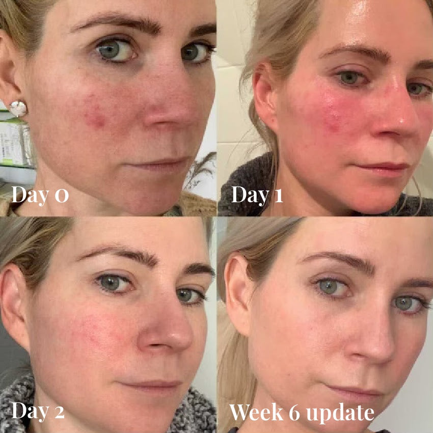 before and after results omnilux led light therapy face mask