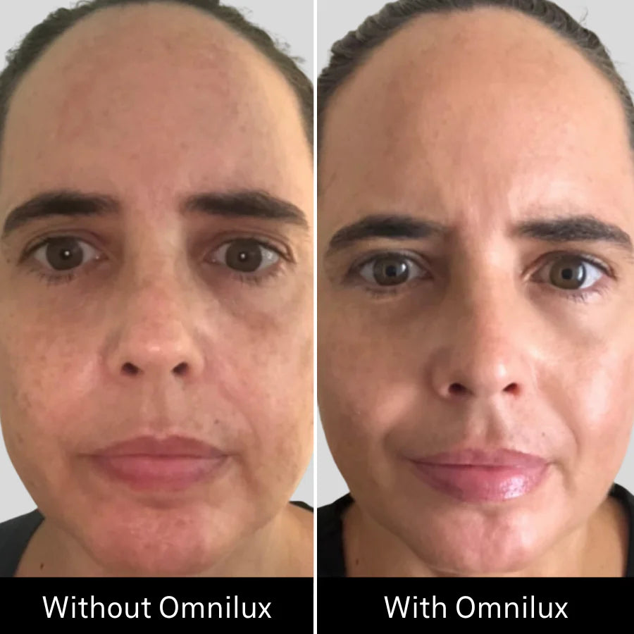 before and after results omnilux led light therapy face mask